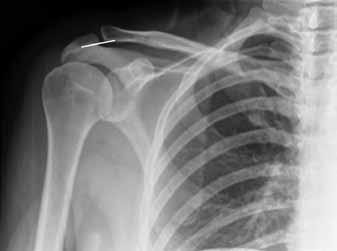 The anterior humeral line (AHL) is a line drawn on a true lateral projection along the anterior cortex of the humerus and should have approximately one third of the capittellum lying anterior to the