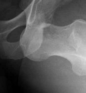 Anterior hip dislocations are also associated with a femoral head fracture.