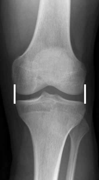 Lateral view: On the lateral view the ratio of the patella ligament length to the patella length should be in the range of 0.8-1.2 [7] (see 12 www.sorsa.org.