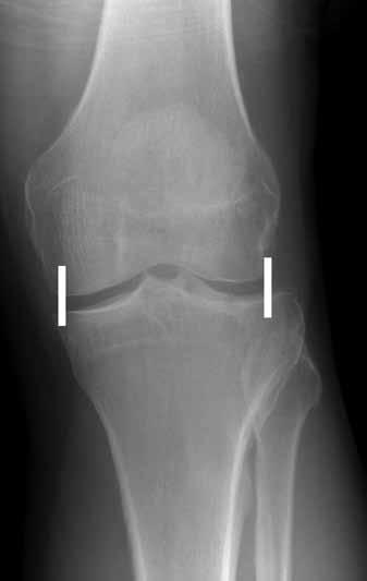 On the lateral view the long axis of the distal tibia and fibula should overlap [7]. See Figure 8 demonstrating a lateral talar shift.