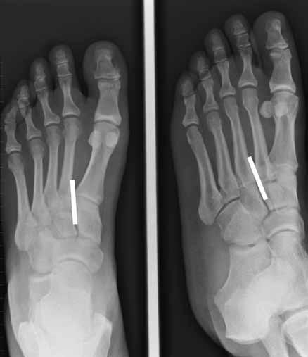 NOVEMBER 2013 volume 51 number 2 THE SOUTH AFRICAN RADIOGRAPHER Figure 9a Figure 9b Figure 10a Galeazzi fracture of the radius