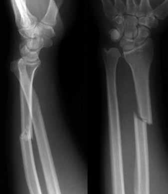 Figure 11b demonstrates an intra-articular comminuted fracture at the base of the 1st metacarpal joint; also known as a Rolando