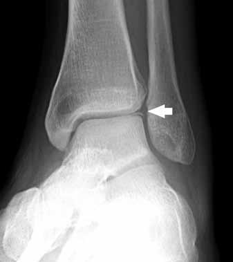 Check for additional fractures or dislocations as can be seen in Figure 11c which demonstrates a typical Monteggia fracture with