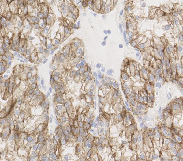 Clear cell RCC Immunohistochemistry CK and vimentin positive CA IX positive (diffuse, membranous) Usually CK7