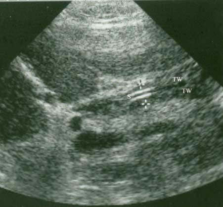 Longitudinal sonogram through the porta hepatis of a patient with the correct diagnosis of cholangitis (case 2).