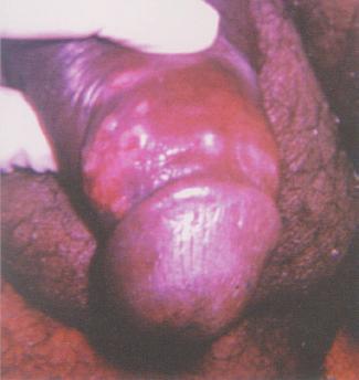 chancroid, granuloma inguinale or lymphogranuloma venereum Aspirate any fluctuant gland if required through surrounding healthy skin (surgical incision should be avoided) Educate and counsel on risk