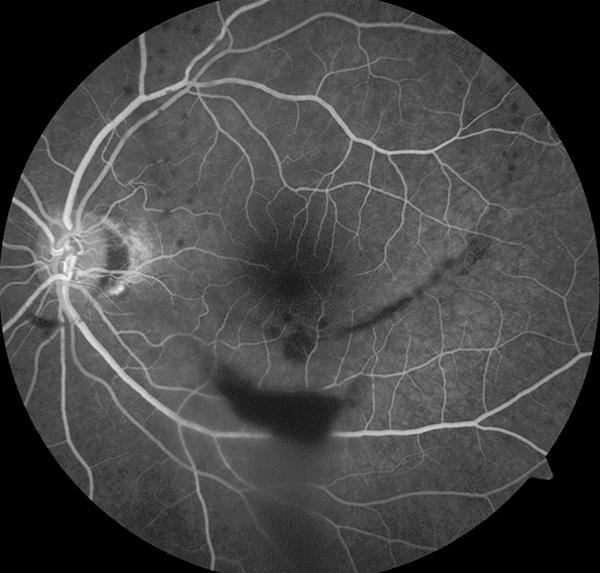 Figure 5. Fundus fluorescein angiography (FFA) of the patient 1 week after the laser treatment: 26 seconds. diagnosed with Valsalva retinopathy.