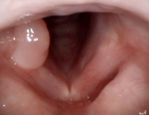 nodules, polyps, cysts, granuloma, papilloma, leukoplakia - Usually well-circumscribed vocal fold lesions that do not usually obstruct airway - Can interfere