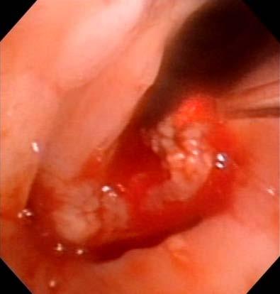 MANAGEMENT BASED ON LARYNGOSCOPY - Vocal fold masses - Neoplastic- vocal fold mass that often projects into airway - Panendoscopy (direct microlaryngoscopy, bronchoscopy, rigid esophagoscopy) with