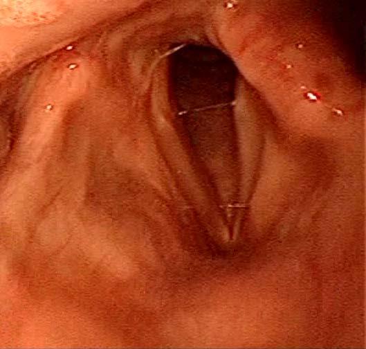 MANAGEMENT BASED ON LARYNGOSCOPY - Vocal fold paresis or paralysis - Correlate with patient history.