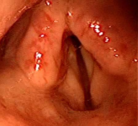 (treatment of voice, aspiration) - Endoscopic procedures injection of vocal folds to add bulk and reposition affected vocal fold to more midline position - Open procedure