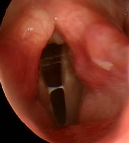 MANAGEMENT BASED ON LARYNGOSCOPY - Laryngopharyngeal reflux (LPR) - Lifestyle modifications: - Avoid trigger foods (spicy, acidic, caffeine), do not eat close to bedtime, elevate head of bed -