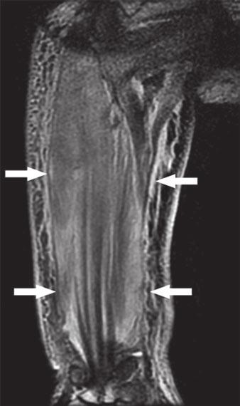 hun et al. Fig. 4 74-year-old woman with systemic recurrence of non-hodgkin s. Images obtained with 1.5-T MRI system.