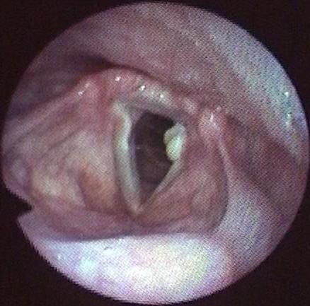 Morbidity Associated With Prolonged Intubation and Mechanical Ventilation Vocal cord granulomas Ulceration of the true vocal cords Circumferential fibrous