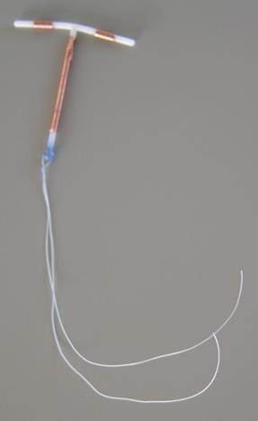 Copper (TCu380A) IUD Lasts up to 10 years 1 st year pregnancy rate 0.5-0.