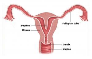 IUD Contraindications Distorted uterine cavity (bicornuate uterus, fibroids distorting cavity, extremely large or small cavity) Active pelvic infection (PID or