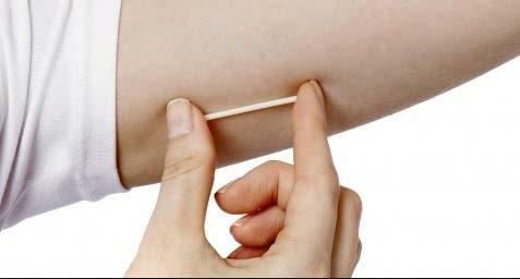 Subdermal Contraceptive Implant Most Brand name Nexplanon Implanon