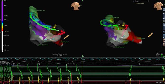 Termination of Atrial Flutter with RF ablation