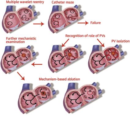 Ablation of AF based on the pathophysiology