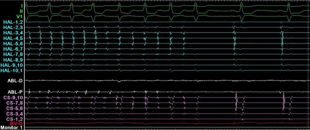 Termination of AF during Ablation Directly to sinus or after conversion to atrial