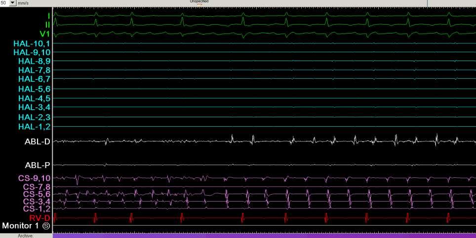 PV Isolation Conversion to atrial