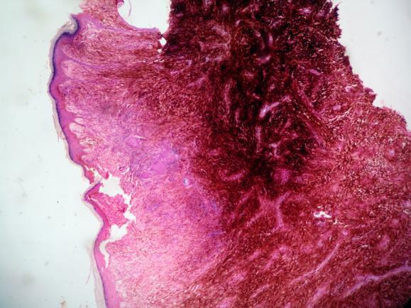 Appendage Tumors and Hamartomas of the Skin. In: Wolff K, Goldsmith L, Katz S, Gilchrest BA, Paller AS, Leffell DJ, edi. Fitzpatrick's Dermatology in General Medicine, 7th ed.