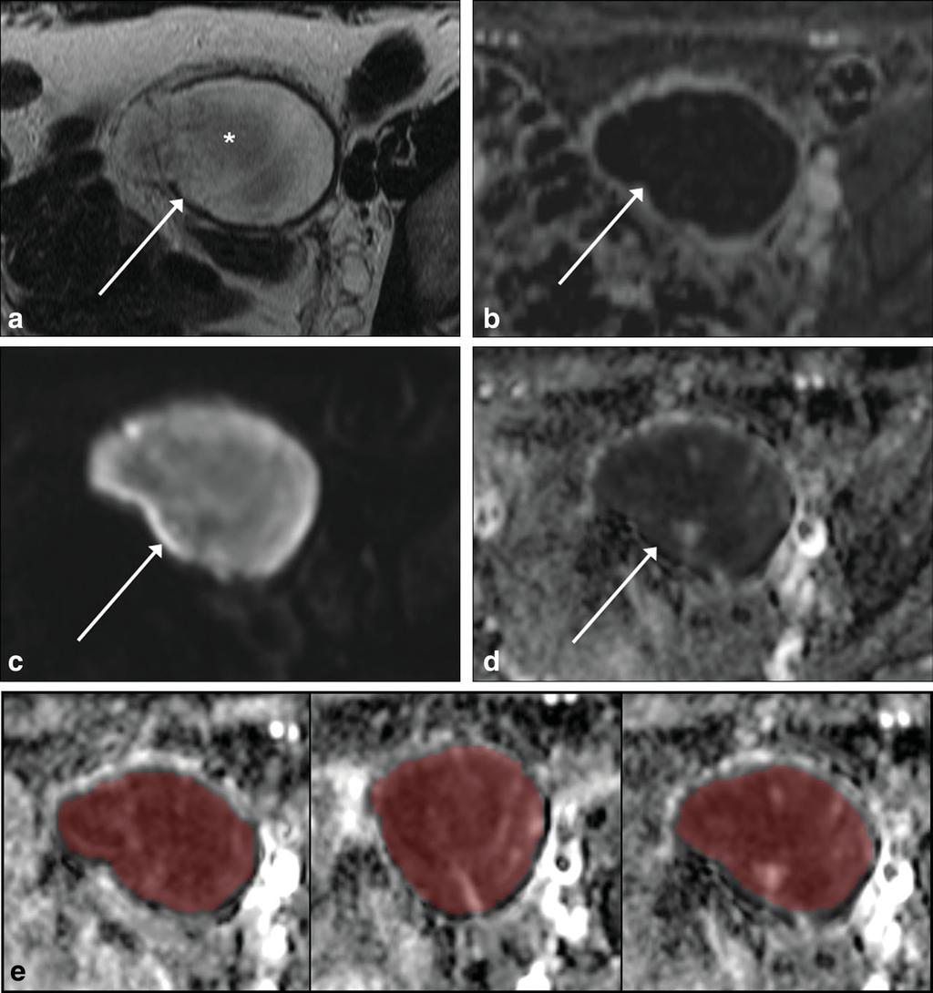 168 Kierans et al. Figure 1. A 51-year-old female with pathologically confirmed left ovarian hemorrhagic cyst.