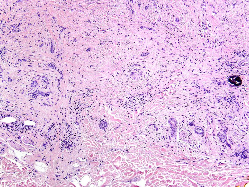 spiradenomas & Brooke-Spiegler Digital papillary adenocarcinoma Sebaceous tumors & Muir-Torre