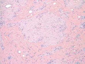 Sclerotic fibroma: CD 34 Desmoplastic trichilemmoma Similar to conventional TL