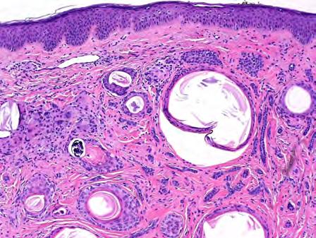 stroma No atypia, low mitotic rate No tumor retraction present Retained Merkel cells on CK20