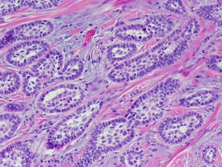 Tumor retraction often present No retained Merkel cells on CK20 stain Trichoepithelioma: Key