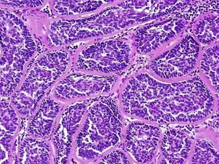 pattern Jigsaw puzzle pattern Small basaloid cells and larger pale cells Small basaloid cells Basement membrane Larger pale cells Spiradenoma Clinical features Most common