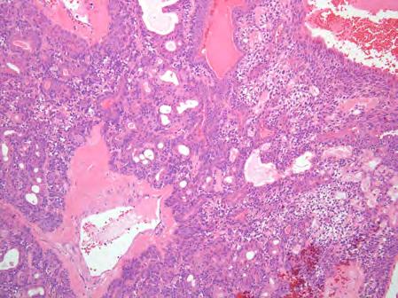 Digital Papillary Adenocarcinoma Clinical features Middle aged adults M>F (7:1)