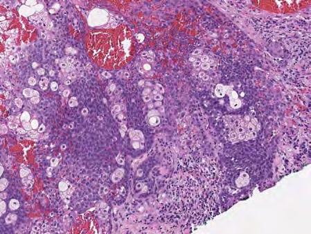 papillary adenocarcinoma Deceptively low-grade adenocarcinoma with recurrence in 50% and metastasis in