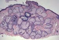sebaceous glands Increased number of glands Lobules of sebaceous glands grouped around follicle DDx: Sebaceous adenoma, nevus sebaceus Sebaceous Adenoma Clinical features