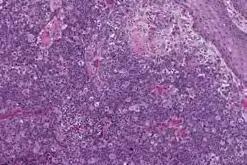 Sebaceous carcinoma of eyelid with pagetoid growth pattern High-grade sebaceous carcinoma Sebocytic differentiation difficult to appreciate 133 Note: cytoplasmic vacuoles indenting nuclei