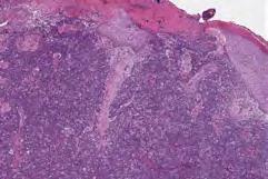 carcinoma Clear cells result of glycogen not lipid (PAS+) Negative for androgen receptor, negative or weak positivity for EMA Melanoma Melanin often present Lacks cytoplasmic vacuoles that indent