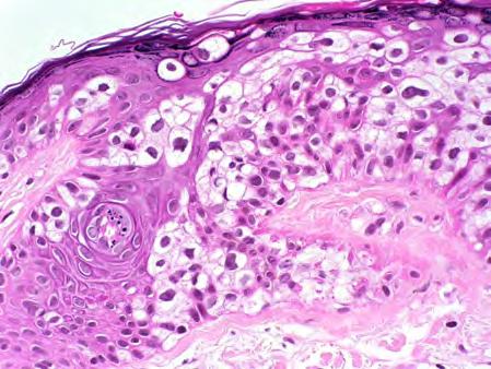 neoplasm and one underlying visceral malignancy Associated visceral malignancies: GI (47%), GU (21%), and breast (12%), most common Skin tumors in MTS: sebaceous adenoma (most common), sebaceous