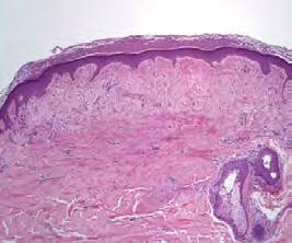 trichodiscomas) and acrochordons Renal tumors Oncocytoma,