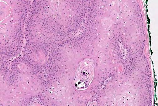 predominant trichodiscoma are histologic variants These lesions are benign 62-year-old female