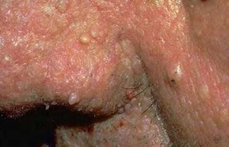 A 33-year-old male with multiple, flesh colored papules around the nose Diagnosis?
