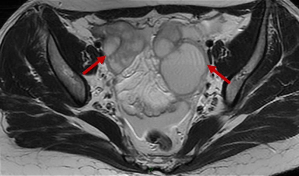 Fig. 11: T2W: bilateral ovarian