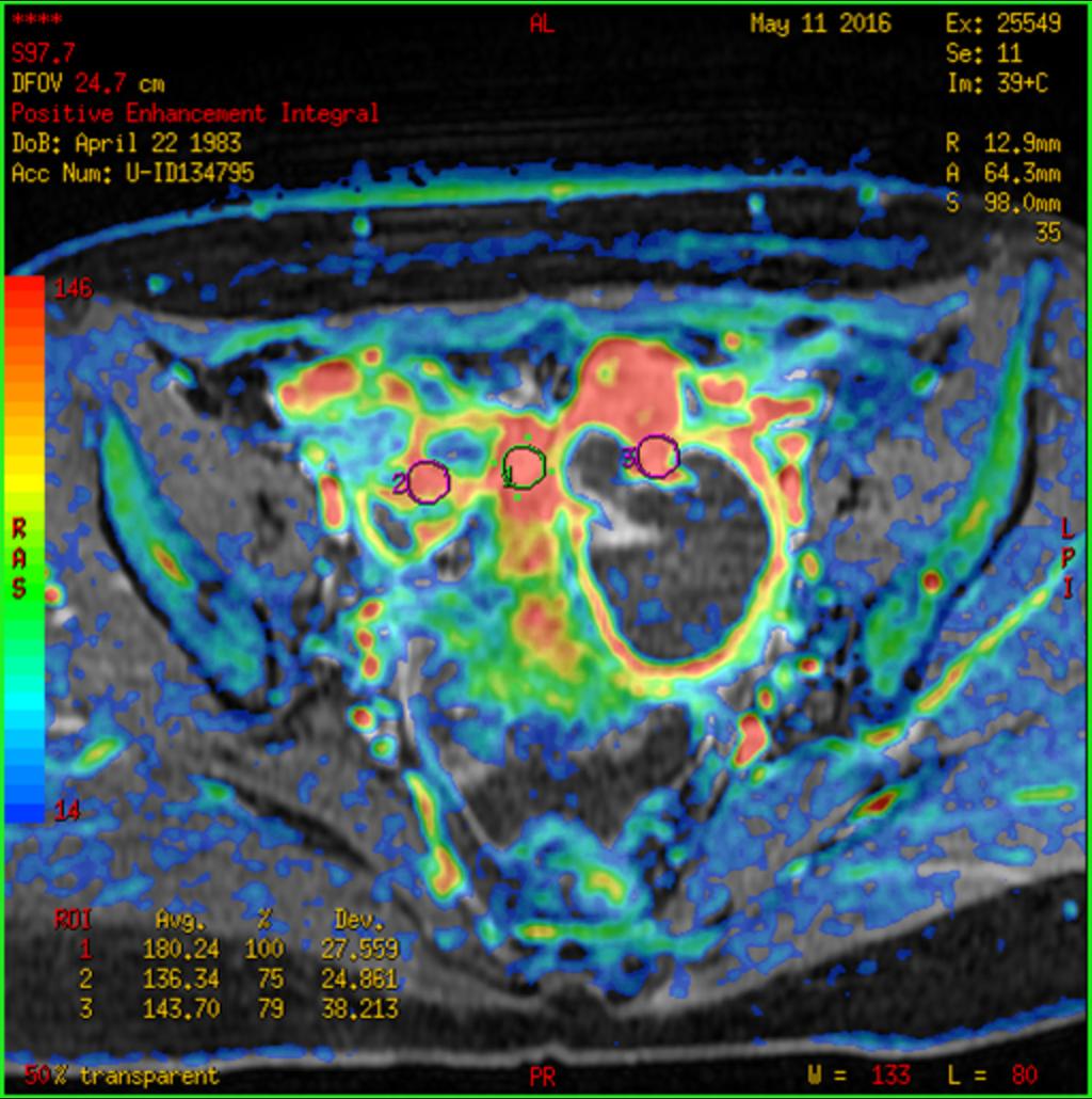 Fig. 13: Perfusion DCE base image: ROI placed on 1.