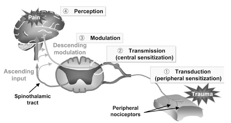 Pain Pathway Stimulation of nociceptors causes signal transduction to the dorsal horn Transduction The spinothalamic tract transmits the signals to the brain where pain is first experienced