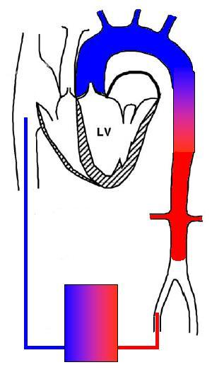Peripheral VA ECMO is not indicated for ARF because Flow competition in the aorta Heart vs.
