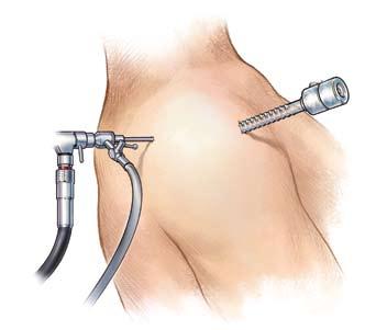 Surgical Technique Rotator Cuff Repair Figure 1 Figure 2 Portal Placement Beach chair or lateral decubitus position is utilized per surgeon preference.