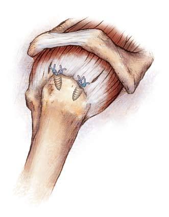 The MaxBraid Suture is loaded approximately 2 cm from the end of the suture, passed through the tendon, and then brought back out the lateral portal with the BiPass Suture Punch.