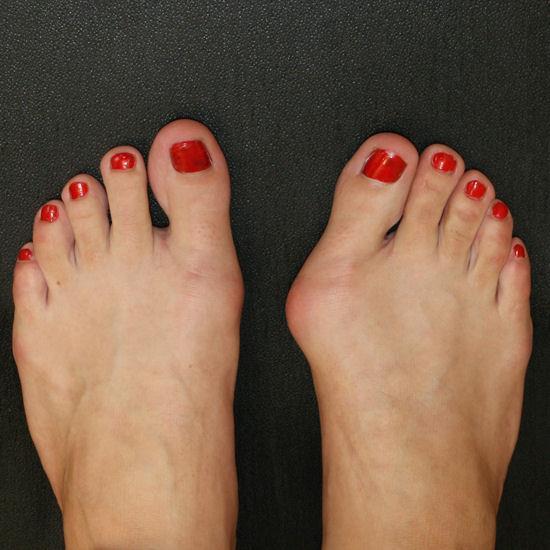 Hallux Valgus A deformity in which the 1 st metatarsal migrates medially, while the 1 st digit migrates laterally Contributing factors include tight footwear as well as genetics Patients present with