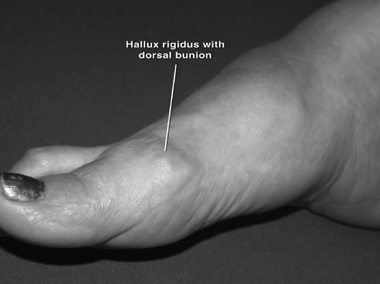 Hallux Rigidus The most common arthritic condition of the foot, occurring on the 1 st digit Patients present with pain that is most commonly felt during resisted extension, swelling and stiffness,