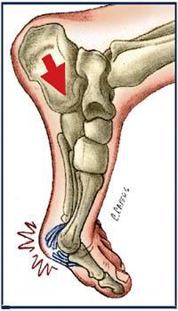 Turf Toe A hyperextension injury of the 1 st MTP joint, occurring when the forefoot is planted but the dancer s body continues moving forward Immediate swelling and pain on injury, followed by